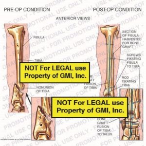 The exhibit illustrates pre-op vs. post-op conditions showing anterior view of pre-op condition with fibula, tibia, nonunion of tibia; and post-op condition with, bone graft fusion of tibia, bone graft fusion of tibia to talus, rod fixating tibia, screws fixating fibula to tibia, and section of fibula harvested for bone graft.