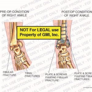 The exhibit illustrates pre-op vs. post-op conditions of right ankle showing pre-op condition of right ankle with fibular fracture, tibial fractures; and post-op condition of right ankle with plate and screws fixating fibular fracture and plate and screws fixating tibial fractures.