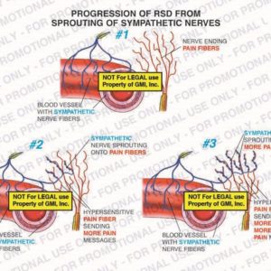 The exhibit illustrates the progression of Reflex Sympathetic Dystrophy (RSD) from the sprouting of sympathetic nerves including blood vessel with sympathetic nerve fibers, nerve ending pain fibers, sympathetic nerve sprouting onto pain fibers, and hypersensitive pain fibers sending more and more intense pain messages.