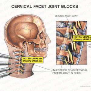 The exhibit illustrates C3-4, C4-5, C5-6, and C6-7 facet block injections in the neck showing cervical facet joints and nerve root.