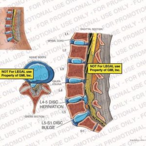 The exhibit illustrates L4-5 disc herniation and L5-S1 disc bulge of the lumbar spine, with sagittal and cross section views, showing spinal cord, nerve roots, cauda equina, L4-5 disc herniation, and L5-S1 disc bulge.