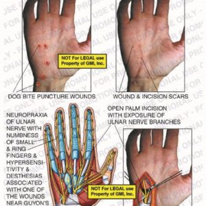 The exhibit illustrates dog bite puncture wounds, wound and incision scars, neuropraxia of ulnar nerve with numbness of small and ring fingers, hypersensitivity and desthesias associated with one of the wounds near guyon's canal, deep motor branch of ulnar nerve, and open palm incision with exposure of ulnar nerve branches.