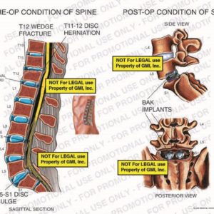 The exhibit illustrates pre-op vs. post-op conditions of the spine, with sagittal section and posterior views, showing T12 wedge fracture, T11-12 disc herniation, spinal cord, nerve roots, L5-S1 disc bulge, and interbody fusion BAK implants.