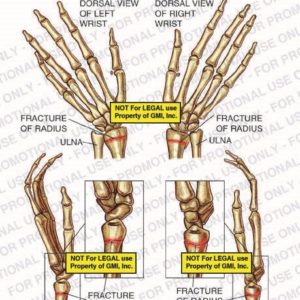 The exhibit illustrates immediate post-accident condition of left and right wrists with lateral and dorsal views showing fracture of radius and ulna.