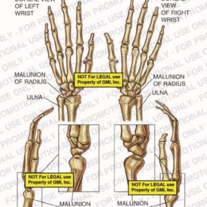 The exhibit illustrates the pre-op condition of left and right wrists with dorsal and lateral views showing malunion of radius and ulna.