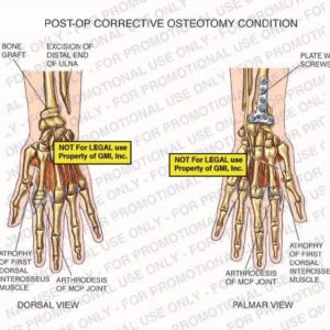 The exhibit illustrates post-op corrective osteotomy condition of wrist with dorsal and palmar views showing bone graft, excision of distal end of ulna, atrophy of first dorsal interosseus muscle, arthrodesis of MCP joint, and plate with screws.