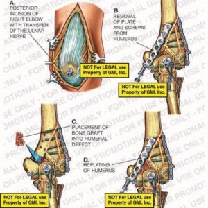 Elbow Surgery or ORIF