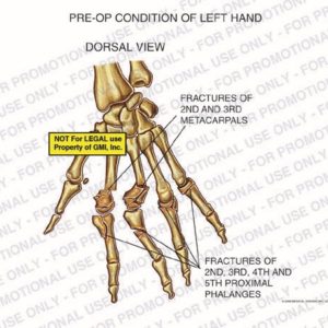 The exhibit illustrates the pre-op condition of left hand with dorsal view showing fractures of 2nd and 3rd metacarpals and fractures of 2nd, 3rd, 4th, and 5th proximal phalanges.