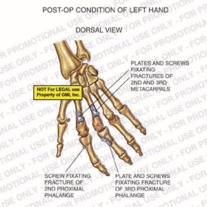 The exhibit illustrates the post-op condition of the left hand with a dorsal view showing plates and screws fixating fractures of 2nd and 3rd metacarpals and 3rd proximal phalange and screw fixating fracture of 2nd proximal phalange.