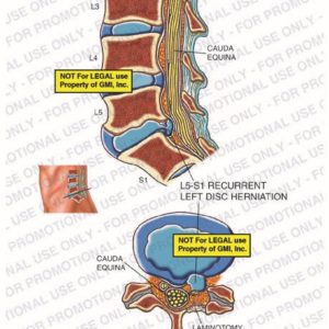 The exhibit illustrates the current post-op condition of the lumbar spine, with sagittal and cross section views, showing cauda equina, L5-S1 recurrent left disc herniation, and laminotomy site.