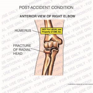 The exhibit illustrates a post-accident condition of right elbow with an anterior view showing humerus and fracture of radial head.