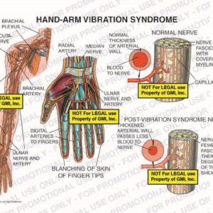 The exhibit illustrates hand-arm vibration syndrome showing a normal nerve and post-vibration syndrome nerve.