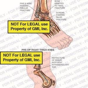 Knee Injury or Hardware