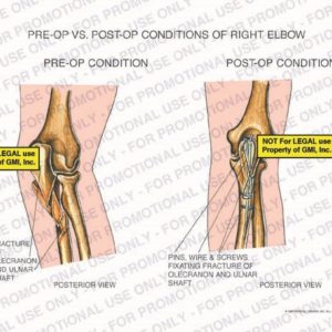 The exhibit illustrates pre-op vs.post-op conditions of right elbow with posterior views showing fracture of olecranon and ulnar shaft and pins, wire, and screws fixating fracture of olecranon and ulnar shaft.