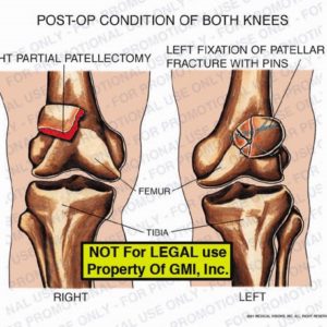 The exhibit illustrates the post-op condition of both knees showing the right partial patellectomy, left fixation of patellar fracture with pins, femur, and tibia.