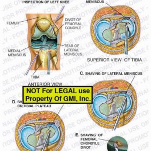 The exhibit illustrates a left knee arthroscopy, with anterior and superior views of the tibia, showing arthroscopic inspection of the left knee, excision of tear of lateral meniscus, shaving of lateral miniscus, shaving on tibial plateau, and shaving of femoral chondyle divot.