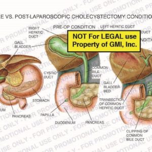 The exhibit illustrates pre and post-laparoscopic cholecystectomy conditions. The pre-op condition shows the right hepatic duct, cystic duct, papilla, duodenum, pancreas, gallbladder, and common bile duct. The post-op condition shows the gallbladder bed, transection of common hepatic duct, and clipping of common bile duct.