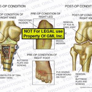 The exhibit illustrates pre-op and post-op conditions of the right knee and pre-op conditions of the right leg and right foot. The pre-op condition of the right knee shows pus in knee joint, a cut-away view of osteomyelitis of tibia, and buttress plate and screws. The post-op condition of the right knee illustrates removal of pus in knee joint, removal of buttress plate and screws, and non-union posterior medial tibial plateau fracture. The pre-op conditions of the right leg and foot show the incisions and pus oozing from wound on foot.