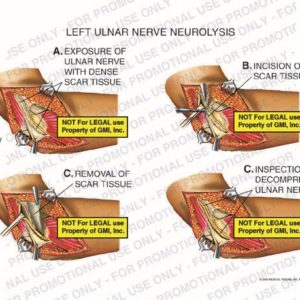 The exhibit illustrates left ulnar nerve neurolysis showing exposure of ulnar nerve with dense scar tissue, incision of scar tissue, removal of scar tissue, and inspection of decompressed ulnar nerve.