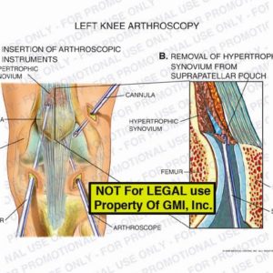 The exhibit illustrates a left knee arthroscopy showing insertion of arthroscopic instruments and removal of hyperthrophic synovium from suprapatellar pouch.