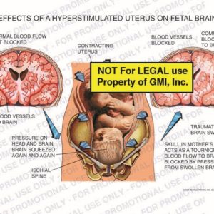 The exhibit illustrates the effects of a hyperstimulated uterus on a fetal brain, showing, normal blood flow not blocked, contracting uterus, pressure on head and brain with the brain squeezed again and again, traumatized brain swelling, and compromised blood flow to the brain.