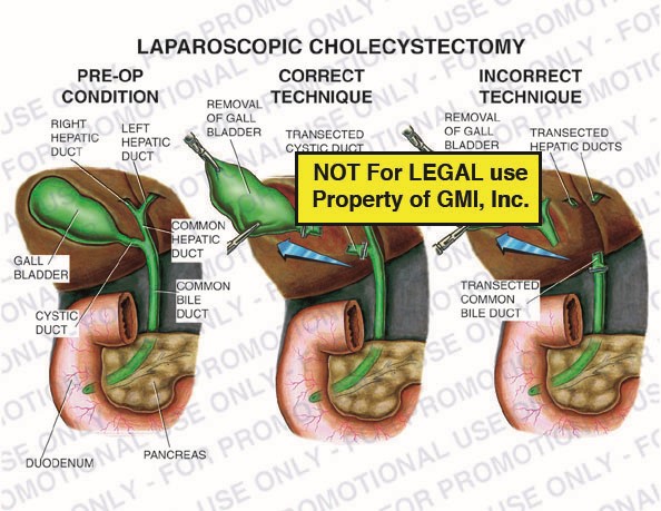 Laparoscopic Cholecystectomy 96050a – Generic Medical Legal Exhibits, A ...
