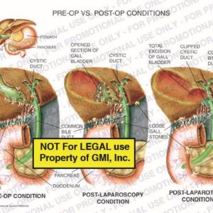 The exhibit illustrates the pre-op condition vs. the post-laparoscopy condition of the gallbladder. The pre-op condition includes the gallbladder, cystic duct, liver, adhesions, pancreas, duodenum, and common bile duct. Post-laparoscopy conditions show the opened section of the gallbladder, total excision of the gallbladder, loose gall stones, and a clipped cystic duct.