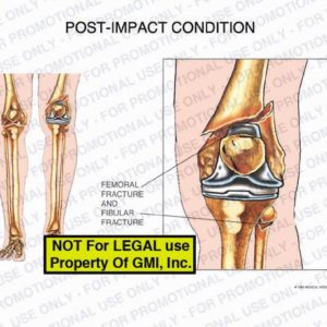 The exhibit illustrates the post-impact condition of the left knee showing femoral and fibular fractures.