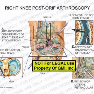 The exhibit illustrates the condition of the right knee post-ORIF arthroscopy showing arthroscopic debridement of scar tissue and synovectomy, shaving of lateral meniscal tear, removal of screw from femur, shaving of undersurface of patella, and incision of lateral retinaculum.