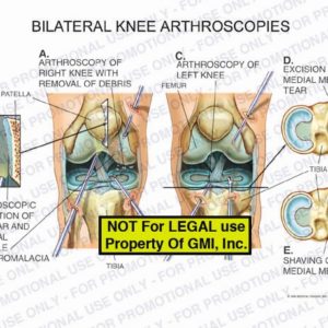 The exhibit illustrates bilateral knee arthroscopies, showing, arthroscopy of right knee with removal of debris, arthroscopic inspection of patellar and femoral condyle chondromalacia, arthroscopy of left knee, excision of medial meniscal tear, and shaving of medial meniscus.