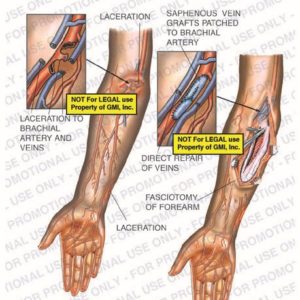 The exhibit illustrates right arm lacerations showing laceration to brachial artery and veins, saphenous vein grafts patched to brachial artery, direct repair of veins, and fasciotomy of forearm.