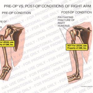The exhibit illustrates the pre-op and post-op conditions of the right arm showing fracture of right humerus and pin fixating fracture of right humerus.