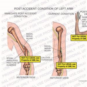 The exhibit illustrates the conditions of the left arm, with anterior and posterior views, showing the immediate post-accident condition vs. the current condition. The immediate post-accident condition shows radial nerve injury and spiral angulated fracture of the humerus. The current condition includes radial nerve, callous formation, and numbness and tingling of left hand due to radial nerve injury.