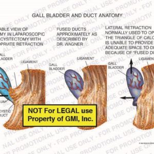 The exhibit illustrates gallbladder and duct anatomy showing the infundibulum of the gallbladder, cystic duct, and ligament.