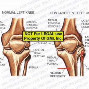 The exhibit illustrates a normal left knee vs. a post-accident left knee showing medial femoral condyle, medial tibial plateau, lateral femoral condyle, patella, lateral tibial plateau, fibula, valgus deformity, and lateral tibial plateau fracture.