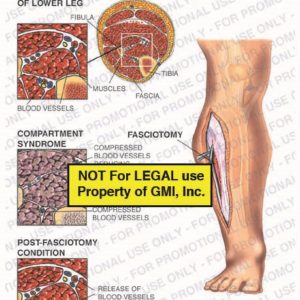 The exhibit illustrates compartment syndrome of the right leg and a fasciotomy, with a normal cross section view of the lower leg, showing compressed blood vessels, muscles, fascia, tibia, fibula, and the release of blood vessels.