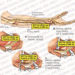 The exhibit illustrates right elbow surgery showing exposure of radial nerve, radial nerve followed up and down arm, and radial nerve freed from surrounding structures.