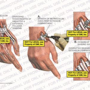 The exhibit illustrates right wrist surgery showing division of retinaculum over first extensor compartment and division of dividing septum.