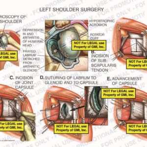 The exhibit illustrates left shoulder surgery showing arthroscopy of left shoulder, incision of subscapularis tendon, incision of joint capsule, suturing of labrum to glenoid and to capsule, and advancement of capsule.
