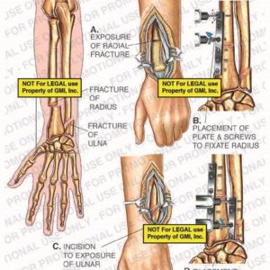 The exhibit illustrates ORIF surgery of the left forearm showing exposure of radial fracture, placement of plate and screws to fixate radius, incision to exposure of ulnar fracture, and placement of plate and screws to fixate ulna.
