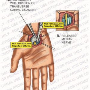 The exhibit illustrates right hand surgery showing palm incision with division of transverse carpal ligament and released median nerve.