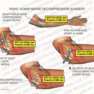 The exhibit illustrates right ulnar nerve decompression surgery showing incision of deep fascia over ulnar nerve, incision of scar tissue band over ulnar nerve, and a decompressed ulnar nerve.