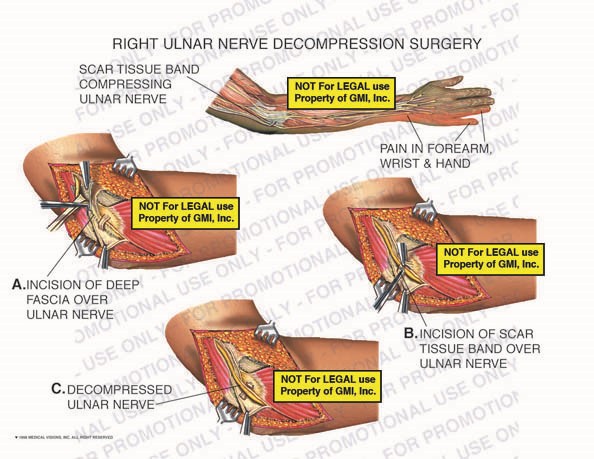 What is the aftercare for ulnar nerve surgery?