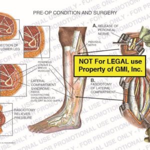 The exhibit illustrates the pre-op condition and surgery of the left leg, with a cross section view, showing lateral compartment syndrome, release of peroneal nerve, and fasciotomy of lateral compartment.