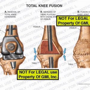 The exhibit illustrates a total knee fusion showing the removal of total knee hardware, merging of tibial plateau with distal end of femur, and fusion of knee joint.