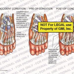 The exhibit illustrates pre-accident, pre-op, and post-op conditions of compartment syndrome in the foot. The exhibit shows swelling of the muscles inside the fascia increasing pressure and cutting off blood supply, foot tendons and muscles, and fasciotomy incisions of fascia to release pressure from swollen muscles.