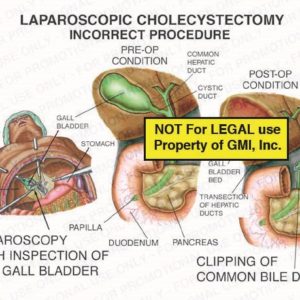 The exhibit illustrates an incorrect procedure of a laparoscopic cholecystectomy showing pre-op and post-op conditions. The pre-op condition includes inspection of the gallbladder, common hepatic duct, cystic duct, pancreas, duodenum, and papilla. The post-op condition shows the gallbladder bed, transection of hepatic ducts, and clipping of common bile duct.