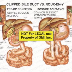 The exhibit illustrates the pre-op condition of a clipped bile duct and the post-op condition with a Roux-en-Y. The pre-op conditions shows the clipped common bile duct, inflammation of right upper quadrant, and adhesions throughout intestines. The post-op condition shows the common bile duct attached to the small bowel, Roux-en-Y of common hepatic duct to small intestine, and lysis of adhesions.
