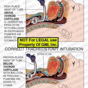 The exhibit illustrates an incorrect tracheostomy intubation vs. a correct tracheostomy intubation. The incorrect tracheostomy intubation shows high placement of tube above thyroid cartilage and lacerating epiglottis with balloon in esophagus pumping air down to stomach. In comparison, the correct tracheostomy intubation details proper placement of tube below thyroid cartilage with balloon in trachea pumping air down to lungs.