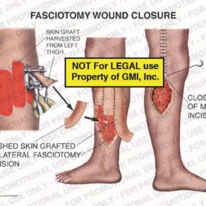 The exhibit illustrates the closure of a fasciotomy wound showing skin graft harvested from the left thigh, meshed skin grafted to lateral fasciotomy incision, and closure of the medial incision.